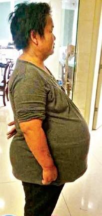 厦门44岁女子肚子变大以为发胖原来长50斤肿瘤